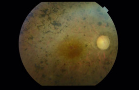 ep retinosis pigmentaria