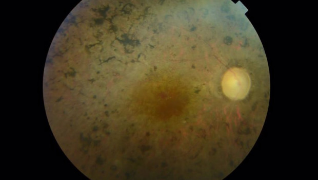 ep retinosis pigmentaria