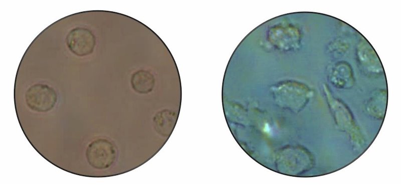 Imagen microscópica de células leucémicas tipo B (izquierda) que se convierten en otro tipo de célula, macrófagos (derecha). | MANEL ESTELLER ep imagen microscopica de celulas leucemicas tipo b izquierda que se convierten en otro tipo de
