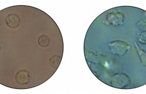 ep imagen microscopica de celulas leucemicas tipo b izquierda que se convierten en otro tipo de