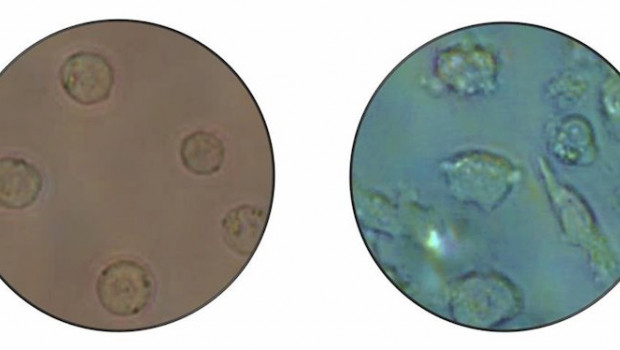 ep imagen microscopica de celulas leucemicas tipo b izquierda que se convierten en otro tipo de