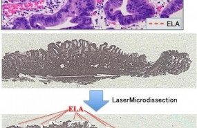 ep la lineapuntos rojos indicaepitelioatipiabajo grado ela que cubresuperficietejido canceroso gastricola imagen superior ela rojo y tejidos cancerosos azul extraidosmicrodiseccion laserla imagen inferior