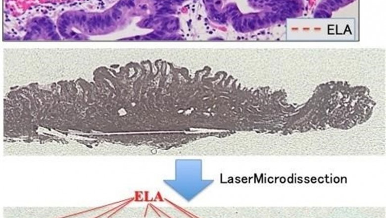 La línea de puntos rojos indica el epitelio de atipia de bajo grado (ELA) que cubre la superficie del tejido canceroso gástrico en la imagen superior. ELA (Rojo) y tejidos cancerosos (Azul) extraídos por microdisección Láser en la imagen inferior. | HIROSHIMA UNIVERSITY ep la lineapuntos rojos indicaepitelioatipiabajo grado ela que cubresuperficietejido canceroso gastricola imagen superior ela rojo y tejidos cancerosos azul extraidosmicrodiseccion laserla imagen inferior