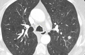 ep deteccion precozcancerpulmon