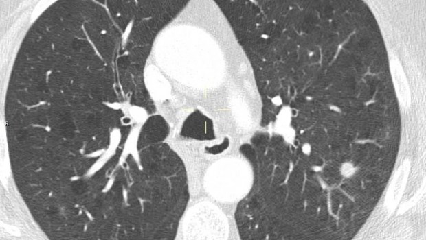 ep deteccion precozcancerpulmon