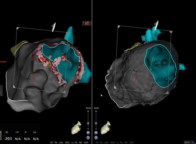Nuevo sistema de navegación ultrapreciso para tratar arritmias complejas | QUIRÓNSALUD ep nuevo sistemanavegacion ultraprecisotratar arritmias complejas