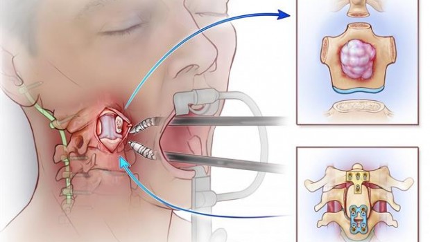ep primera cirugia espinal asistidarobot