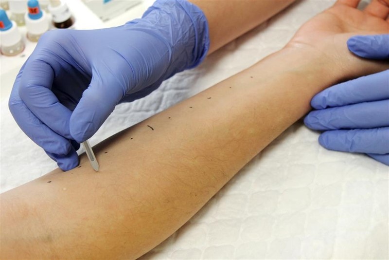 ep pruebas cutaneas de alergia