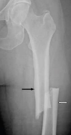 ep fractura atipicafemur