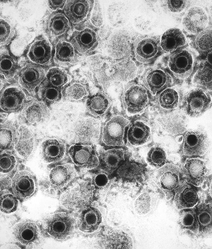 ep herpes simple virus