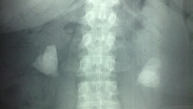 ep piedrasrinon calculos renales litiasis