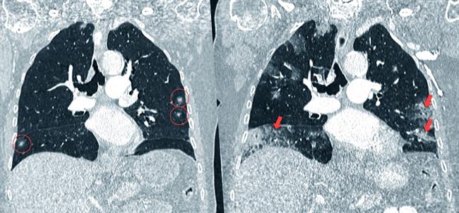 Evolución del cáncer de pulmón | QUIRONSALUD - Archivo ep evolucioncancerpulmon