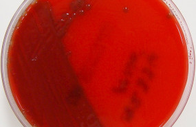 ep meningitis 20200220103004