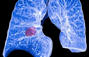 ep cancerpulmon 20180416164301 ep cancerpulmon 20180416164301