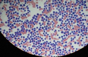 ep leucemia 20170607122910