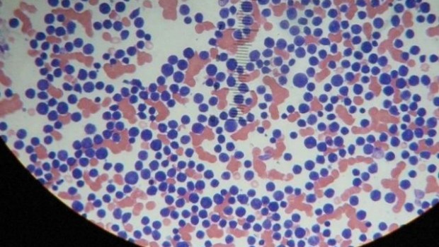 ep leucemia 20170607122910
