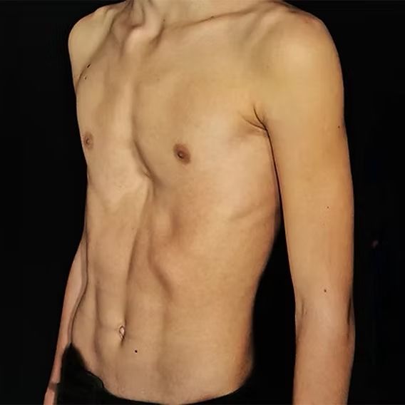 pectus excavatum 20260609125709