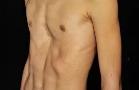 pectus excavatum 20260609125709 pectus excavatum 20260609125709