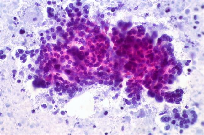 Cáncer de páncreas | FLICKR ED UTHMAN ep cancerpancreas