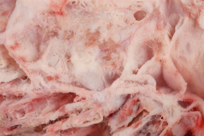 Cáncer de ovario | FLICKR/ED UTHMAN ep cancerovario