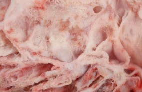 ep cancerovario