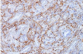 ep celulas tumoralescancerpancreasmodelo krascnio mostrandocolor marronexpresiongalectina-1
