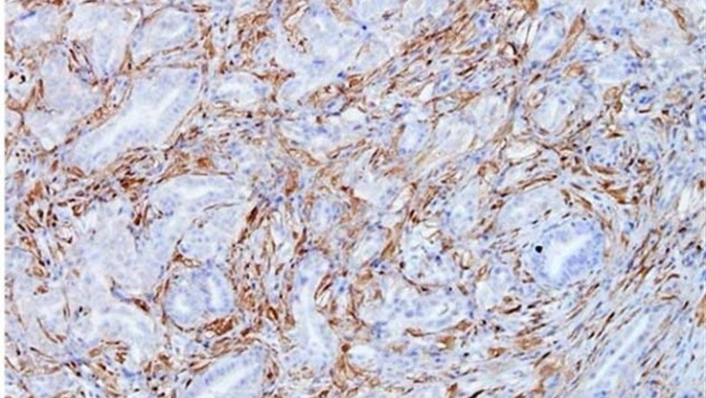ep celulas tumoralescancerpancreasmodelo krascnio mostrandocolor marronexpresiongalectina-1