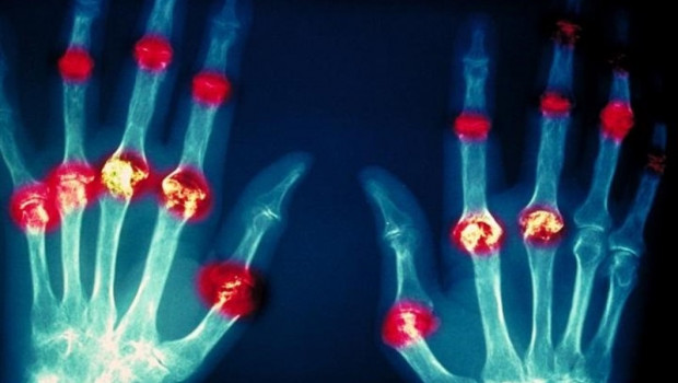 ep investigadores avanzanconocimientodano tisularla artritis reumatoidelupus eritematoso sistemico