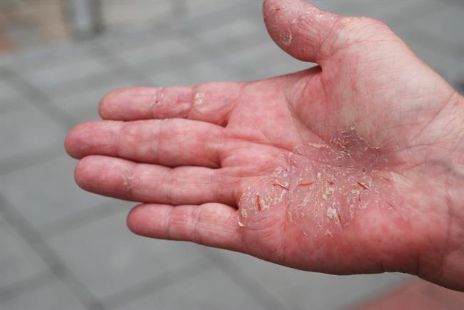ep psoriasis 20180123140107