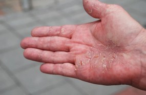 ep psoriasis 20180123140107