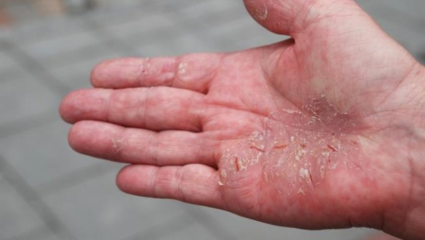 ep psoriasis 20180123140107
