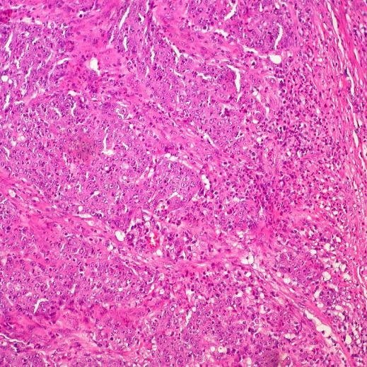 ep cancer de colon