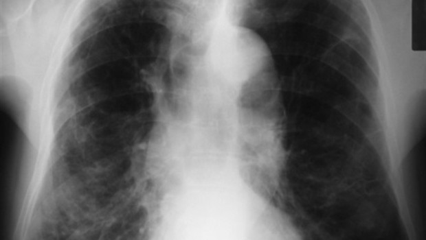 La Rioja.-La Rioja disminuye la tasa de mortalidad por enfermedades respiratoria | FLICKR//PICASA - Archivo ep la rioja-la rioja disminuyetasamortalidadenfermedades respiratoria