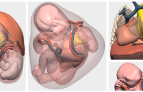 lesin pulmonar feto 1 