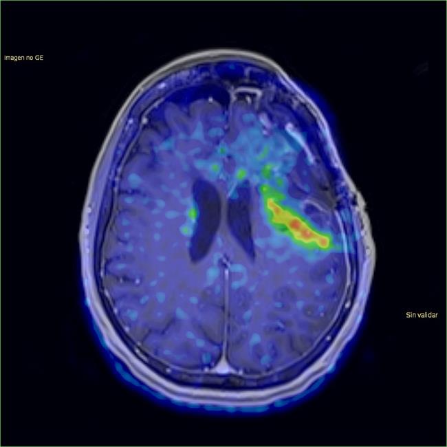 Imagen tumor cerebral | GOBIERNO DE ASTURIAS ep imagen tumor cerebral