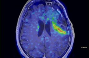 ep imagen tumor cerebral