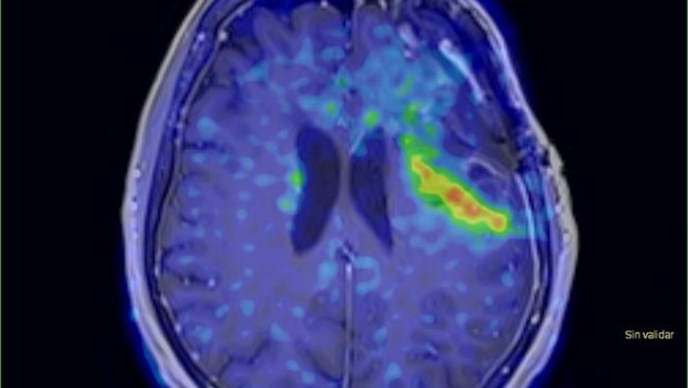 ep imagen tumor cerebral