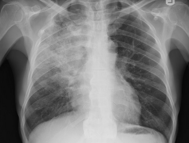 ep radiografia pulmones