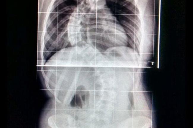 Escoliosis, columna | GoFundMe. ep escoliosis columna