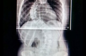 ep escoliosis columna