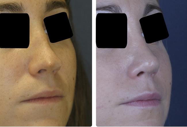 ep rinoplastia secundaria