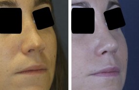 ep rinoplastia secundaria