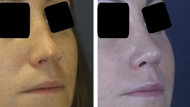 ep rinoplastia secundaria