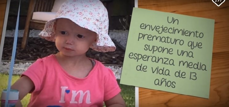 ep alexandra una nina de dos anos con progeria