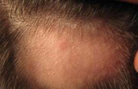 ep hombrealopecia