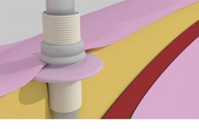 ep collar percutaneo